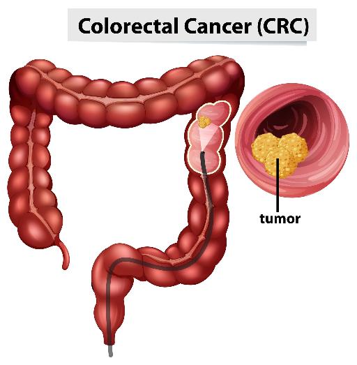 colon