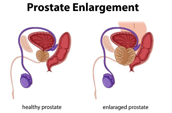 prostate