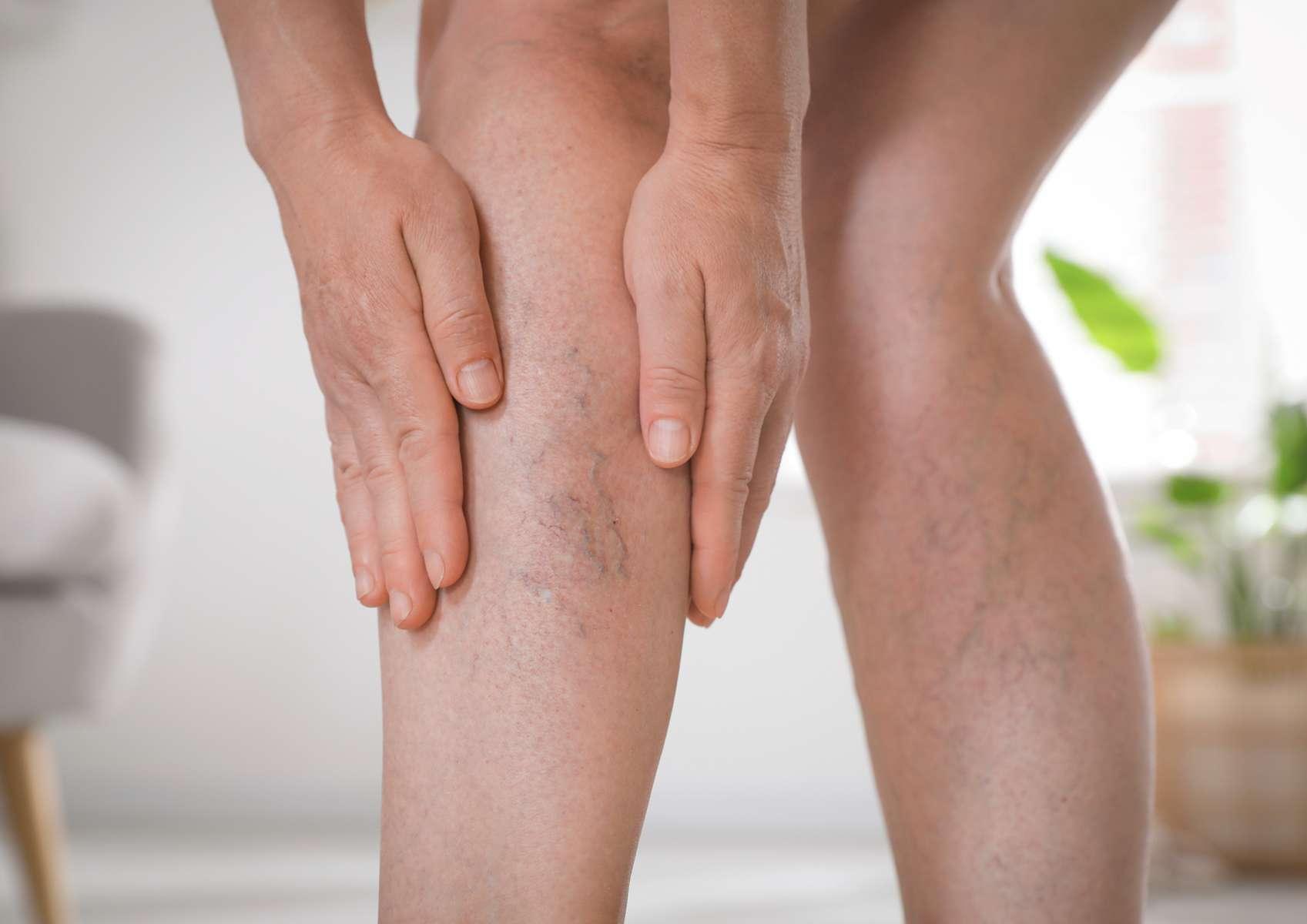 Jambes de femme avec varics